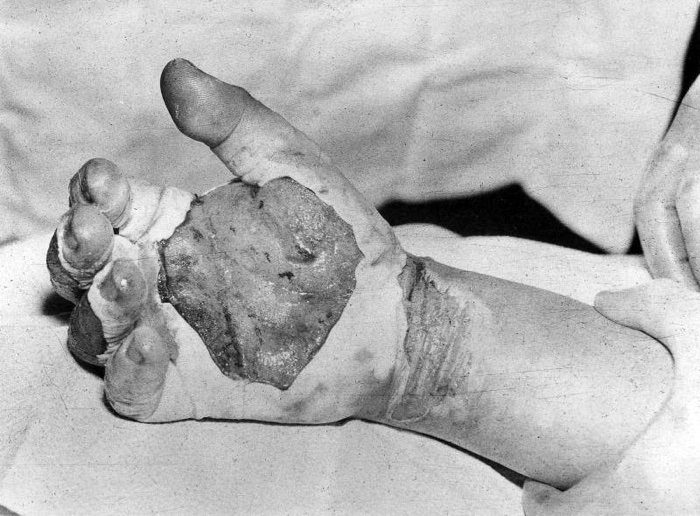 Harry Daghlian's burned and blistered hand.  Photo: Los Alamos National Laboratory