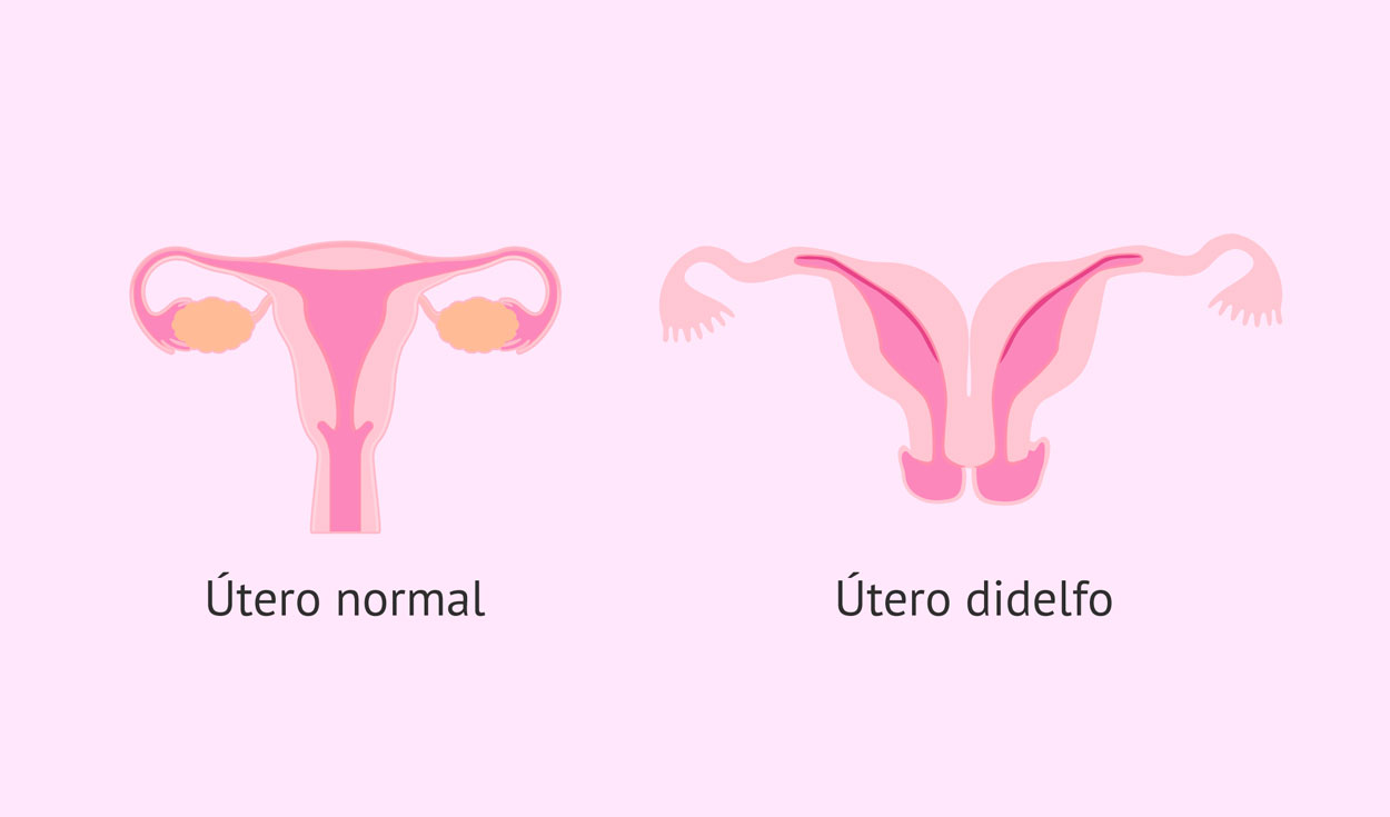 Mujer se somete a una cesárea y descubre que tiene 2 vaginas | Ciencia | La  República