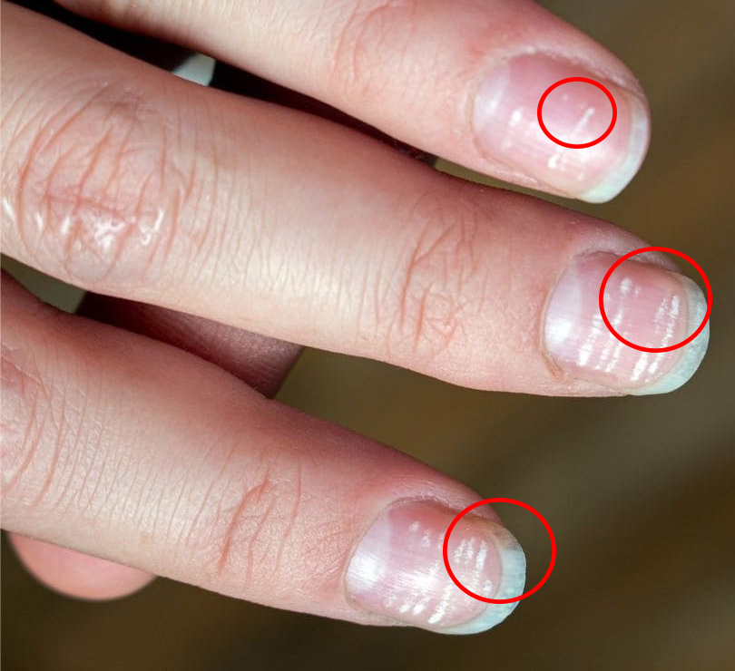 qué aparecen manchas blancas en las uñas de los y cómo eliminarlas? | leuconiquia | tratamiento | atmp | Salud | La República
