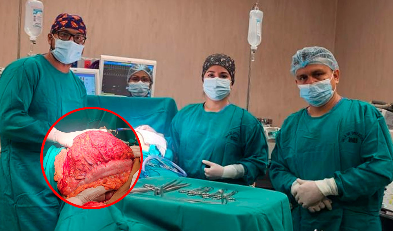 
                                 Médicos de Jaén extraen tumor gigante intraabdominal de un hombre: pesaba 12 kilos 
                            