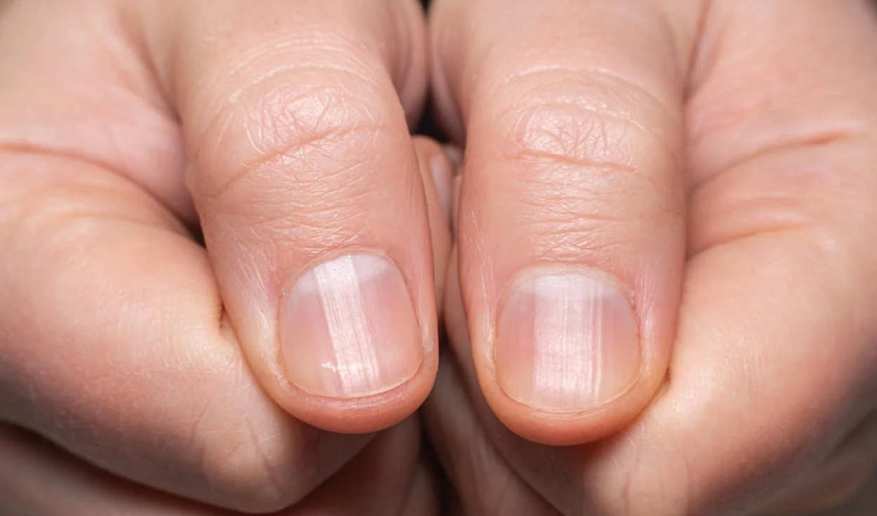 
                                 ¿Tus uñas tienen rayas? Descubre su significado y qué puedes hacer al respecto 
                            
