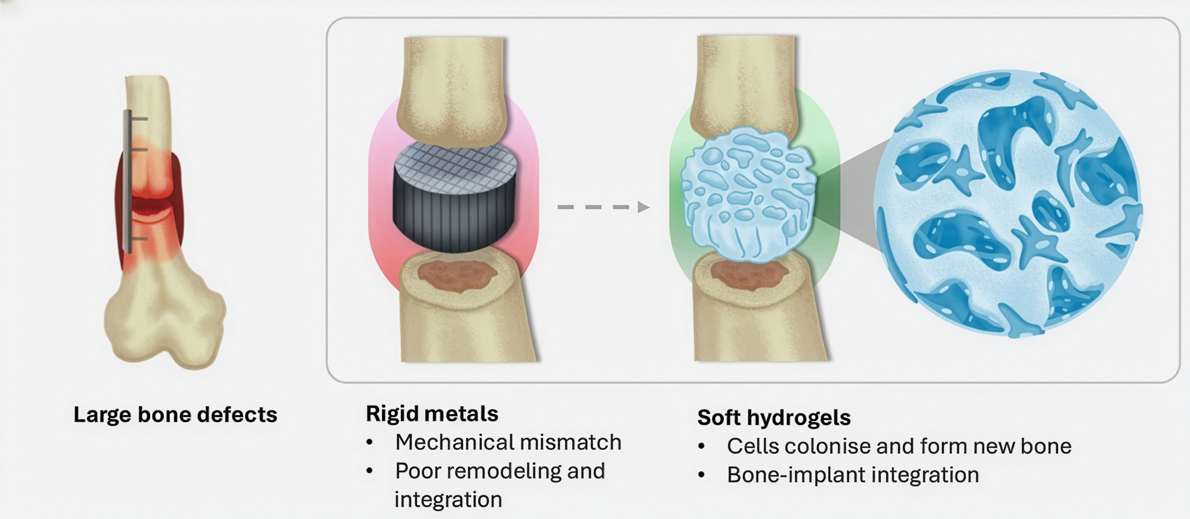 Implantes evolucionan de estructuras rígidas a prótesis blandas con diseño óseo similar al hueso natural. Foto: XH Qin / ETH Zurich