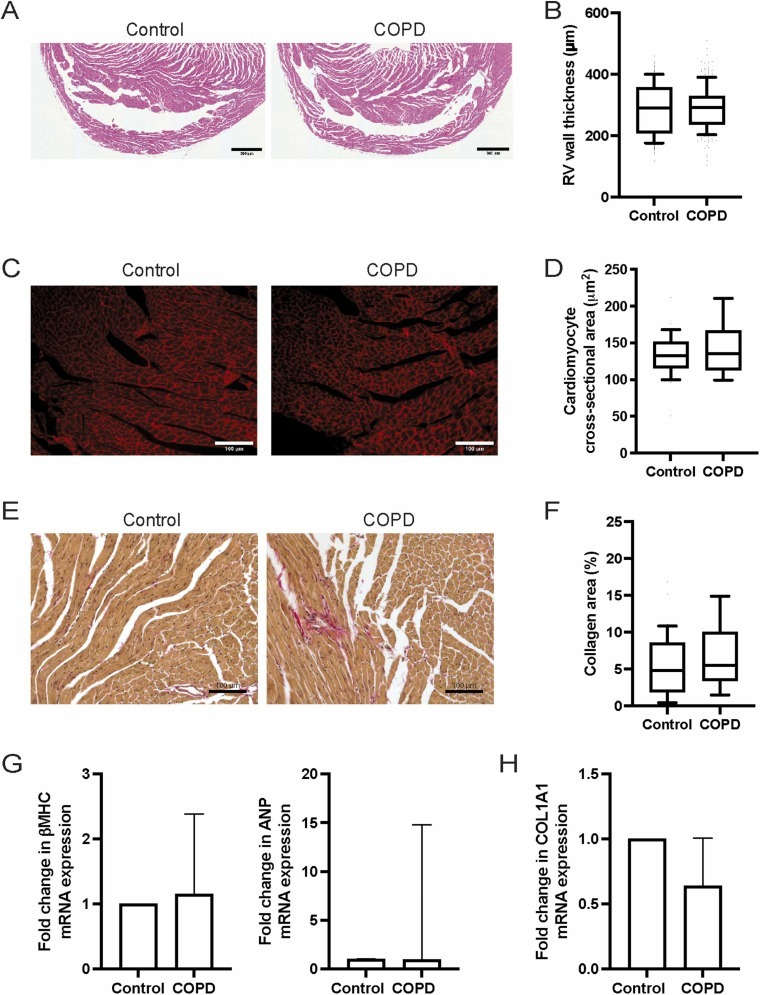 Determinación de marcadores histológicos y moleculares de hipertrofia y fibrosis del ventrículo derecho en el modelo de EPOC. Foto: Science Direct
