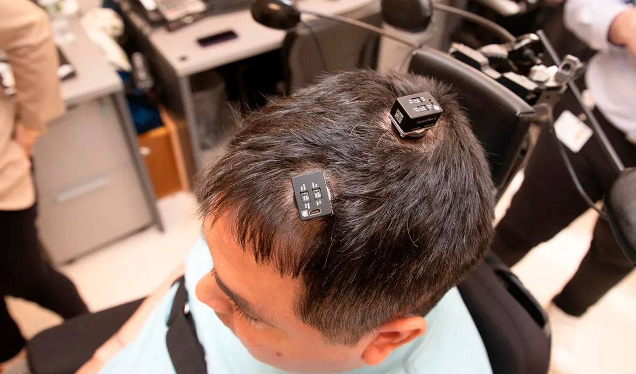 Se implantaron cinco conjuntos de electrodos en el cerebro de Thomas. Foto: Institutos Feinstein para la Investigación Médica