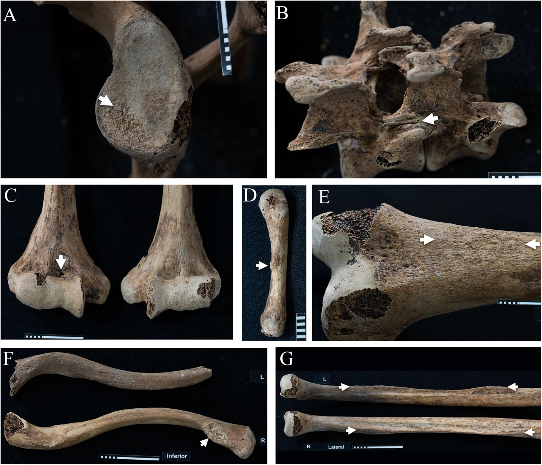 Lesiones y cambios de Ita: glenoide (A), vértebras (B), húmero (C), músculo meñique (D), fémur (E) y ligamentos (F,G). Foto: Frontiers in Environmental Archaeology