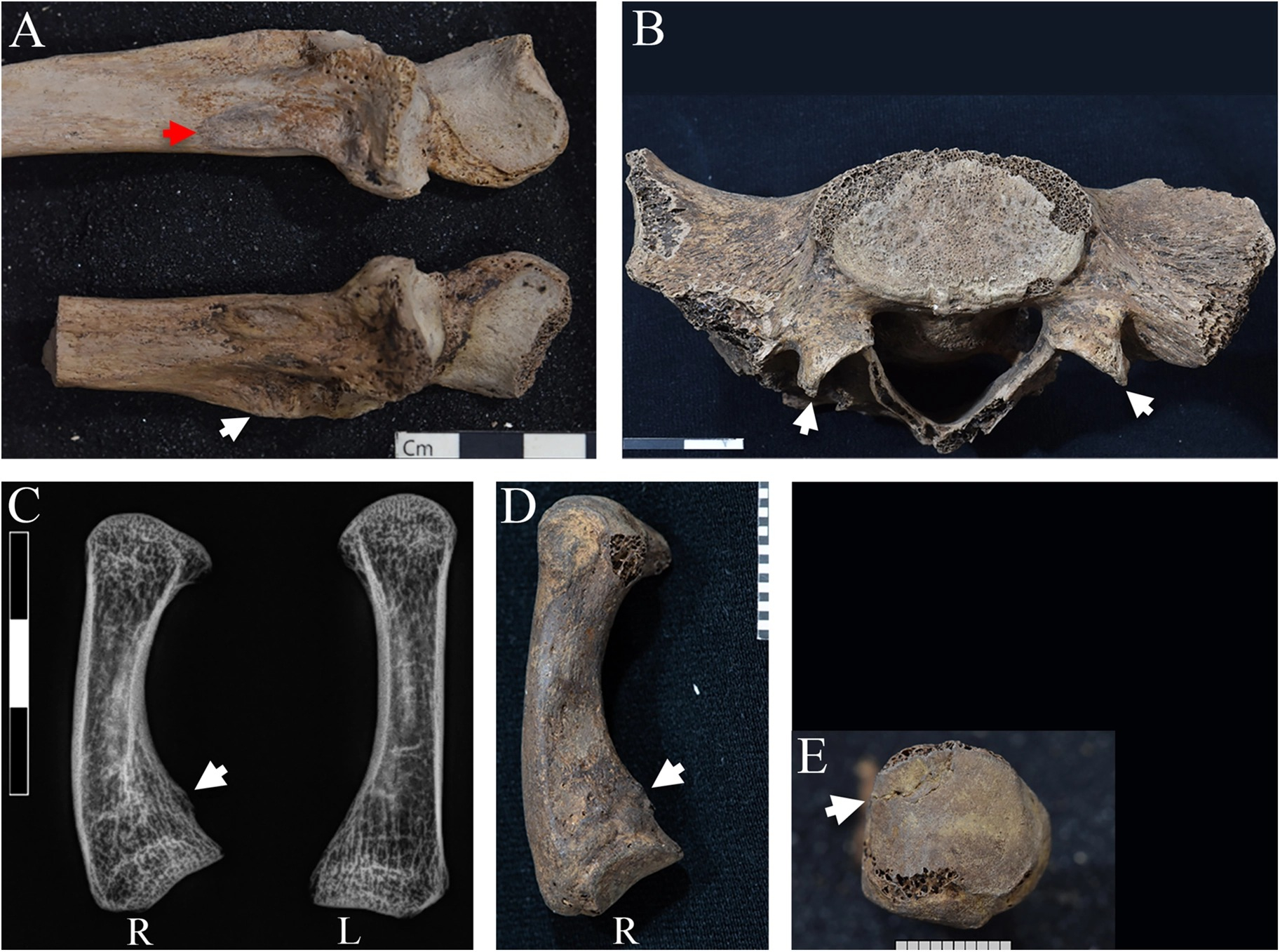 Lesiones de Hor: cúbito (A), sacrolumbar (B), rayos X de metacarpianos (C), callo por trauma (D) y línea de fractura (E). Foto: Frontiers in Environmental Archaeology