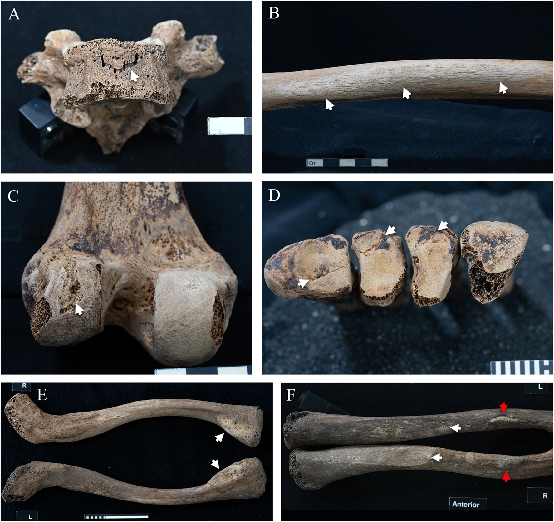 Daños de Itaweret: vértebra (A), fémur (B,C), fracturas en pie (D) y robustez muscular/ligamento en clavículas (E,F). Foto: Frontiers in Environmental Archaeology