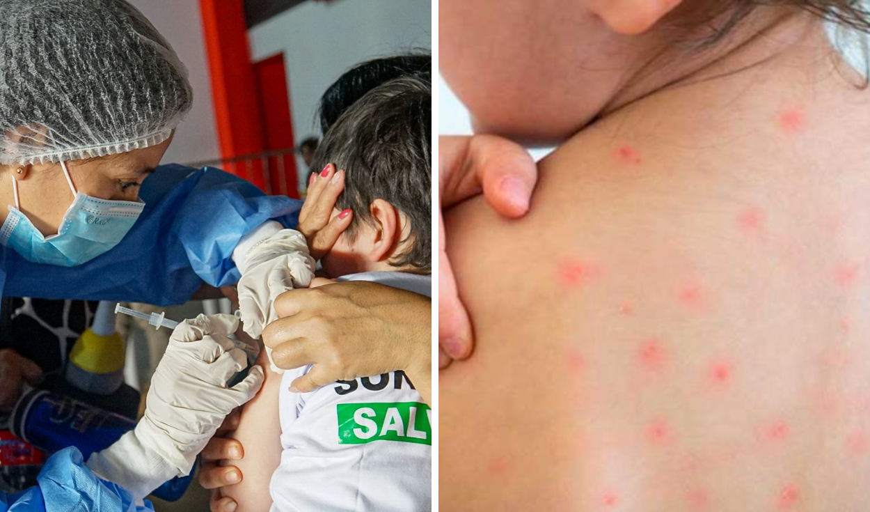 Measles outbreak confirmed in Peru's Loreto region; Ombudsman urges urgent action