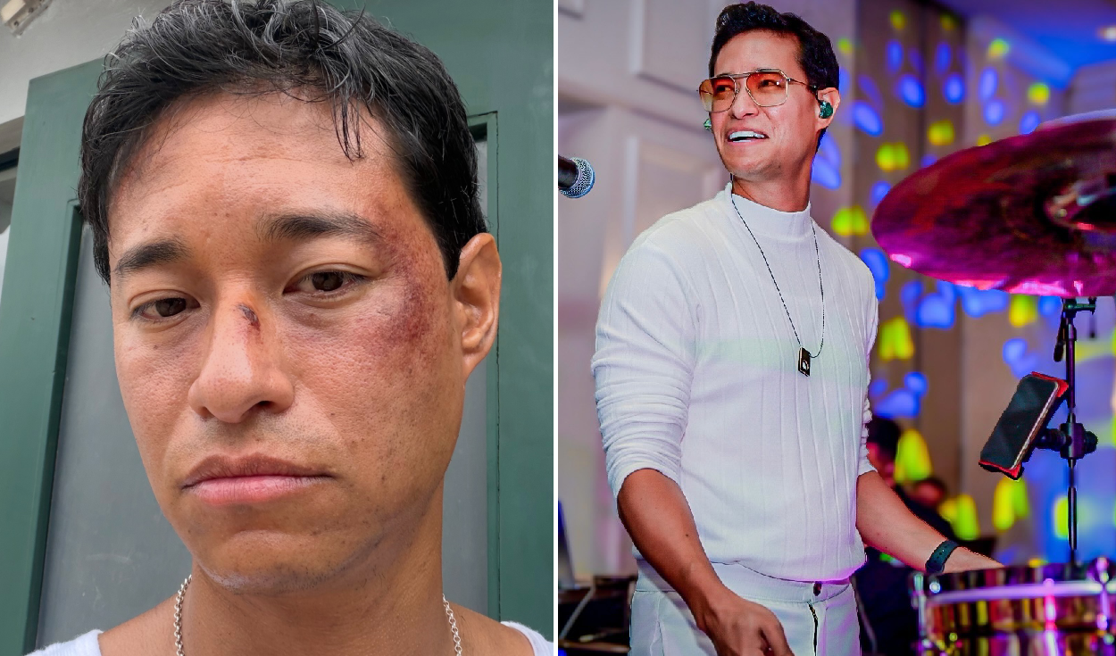 Tony Succar genera ALARMA al aparecer con TERRIBLES MORETONES: “Pudo haber sido peor”