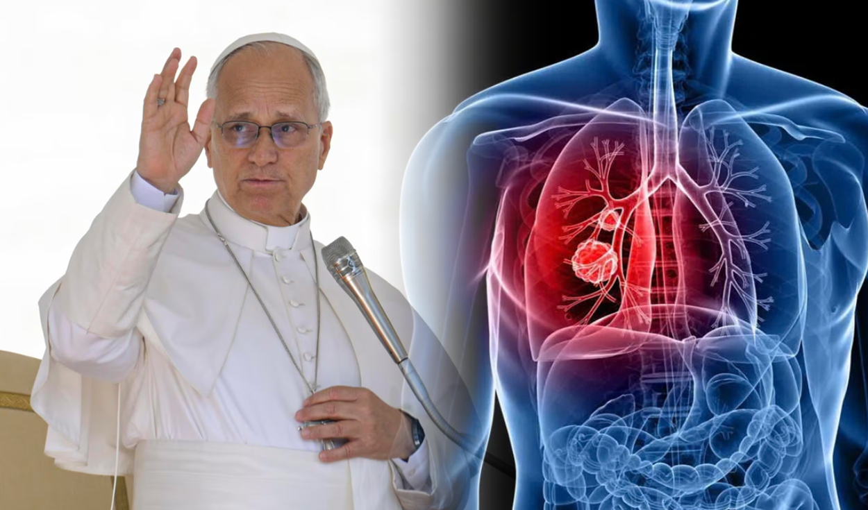 ¿El nódulo pulmonar del papa León XIV podría ser cáncer? Doctor Elmer Huerta qué es y qué riesgo existe en operación